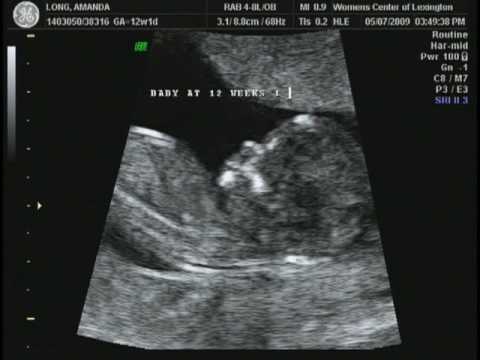 12 Weeks Pregnant Scan Pictures