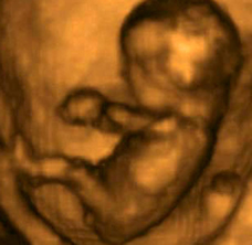 12 Weeks Pregnant Scan Worried