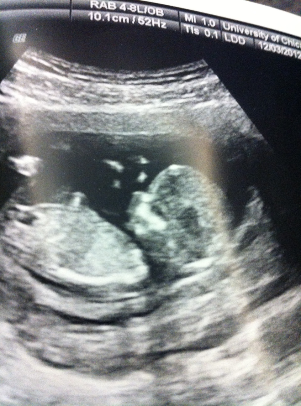 12 Weeks Pregnant Scan Worried