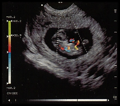 12 Weeks Pregnant Ultrasound Down Syndrome