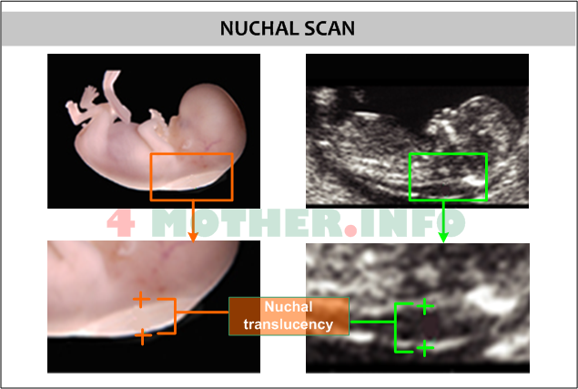 12 Weeks Pregnant Ultrasound Down Syndrome