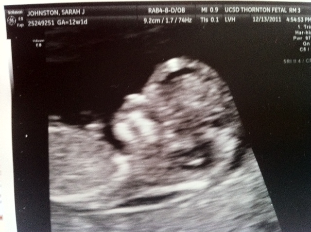 12 Weeks Pregnant Ultrasound Down Syndrome