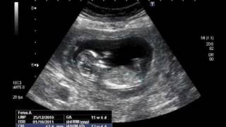 12 Weeks Pregnant Ultrasound Down Syndrome