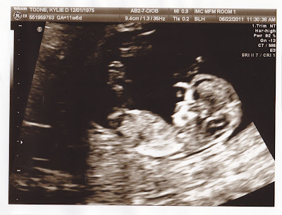 12 Weeks Pregnant Ultrasound Down Syndrome