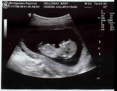 12 Weeks Pregnant Ultrasound Down Syndrome