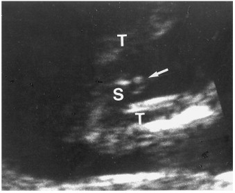 12 Weeks Pregnant Ultrasound Gender Determination