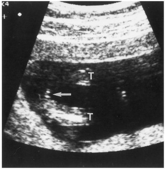 12 Weeks Pregnant Ultrasound Gender Determination