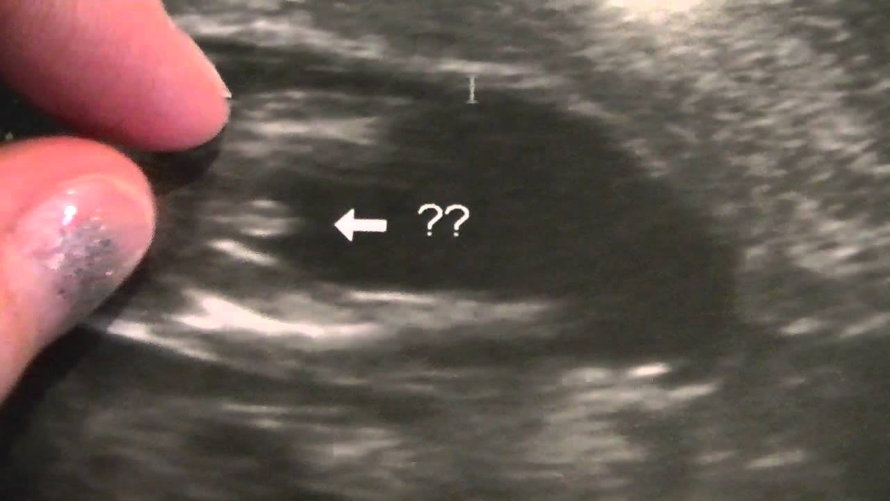 12 Weeks Pregnant Ultrasound Gender Determination