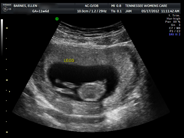 12 Weeks Pregnant Ultrasound Gender Pictures