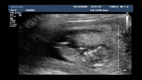 12 Weeks Pregnant Ultrasound Gender Pictures