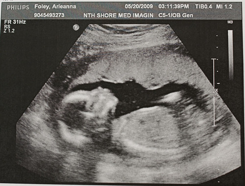 12 Weeks Pregnant Ultrasound Gender Pictures