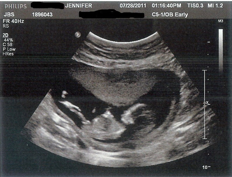 12 Weeks Pregnant Ultrasound Gender Pictures