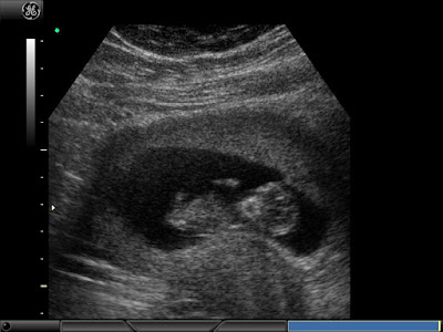 12 Weeks Pregnant Ultrasound Gender Pictures