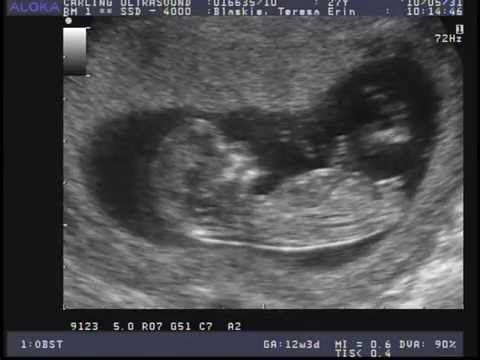 12 Weeks Pregnant Ultrasound Gender Pictures