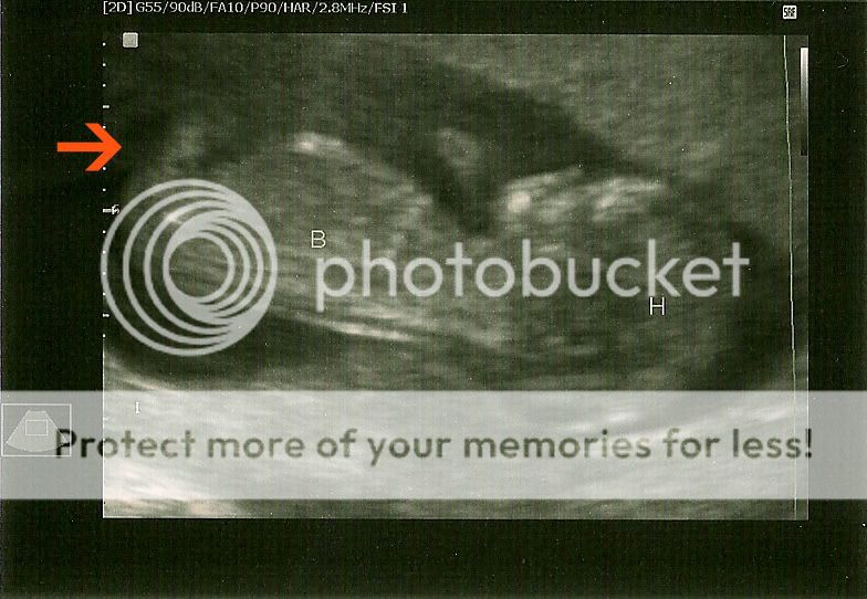 12 Weeks Pregnant Ultrasound Gender Pictures