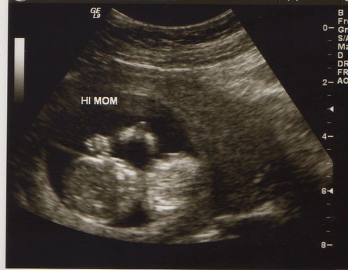 12 Weeks Pregnant Ultrasound Girl