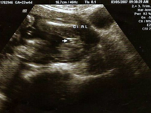 12 Weeks Pregnant Ultrasound Girl