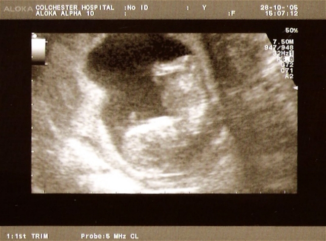 12 Weeks Pregnant Ultrasound Girl