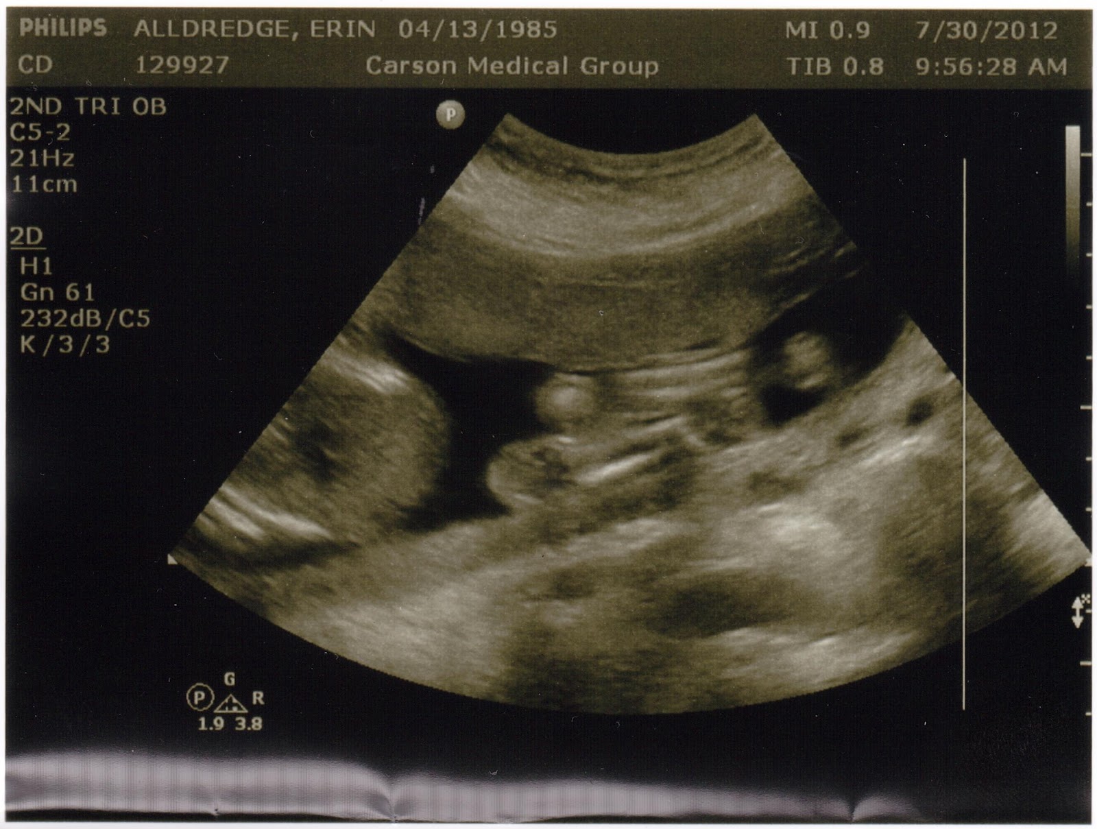 12 Weeks Pregnant Ultrasound Girl