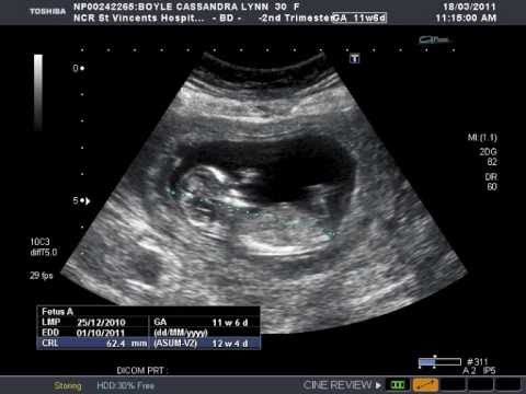 12 Weeks Pregnant Ultrasound Girl