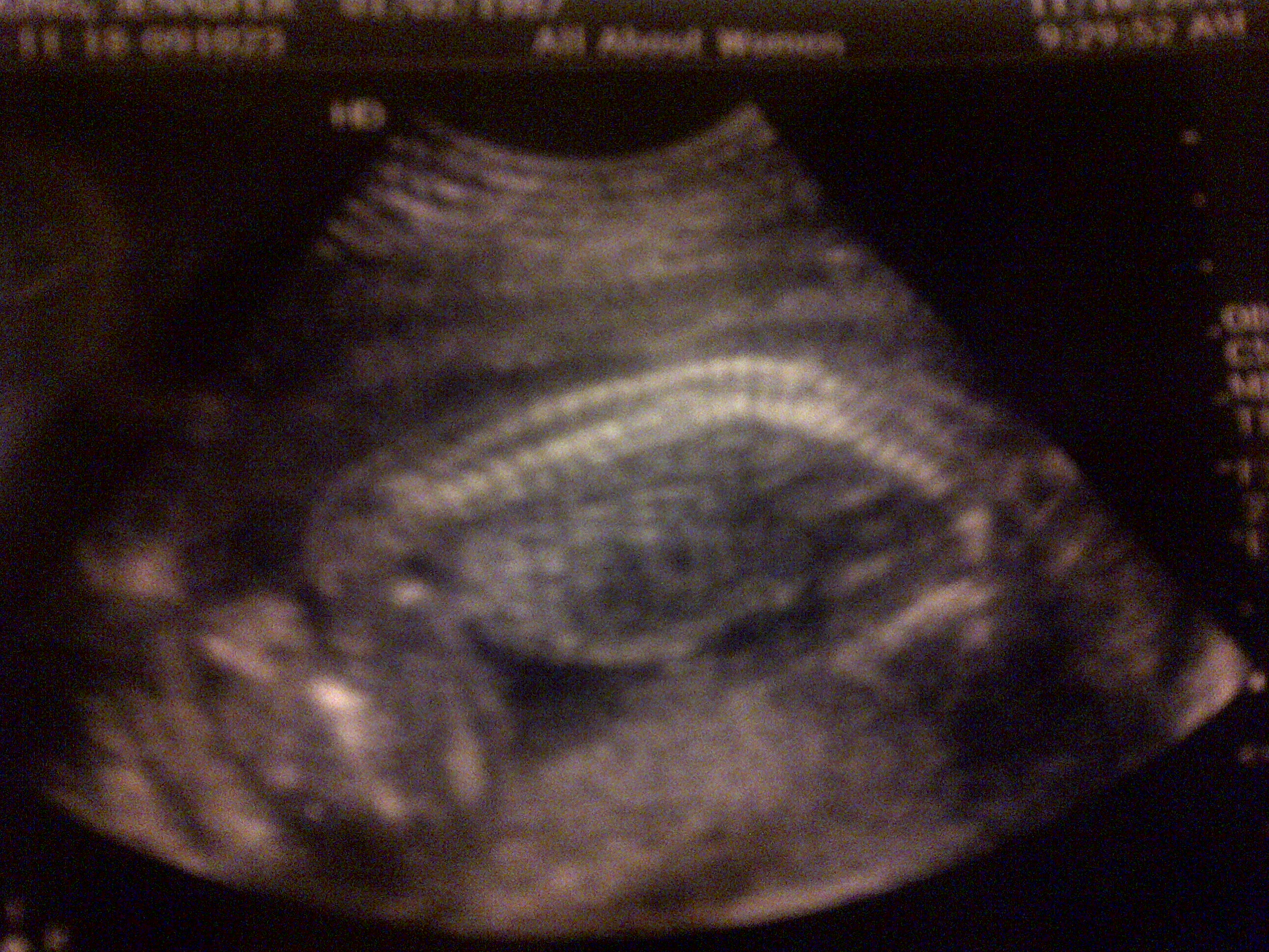 12 Weeks Pregnant Ultrasound Girl