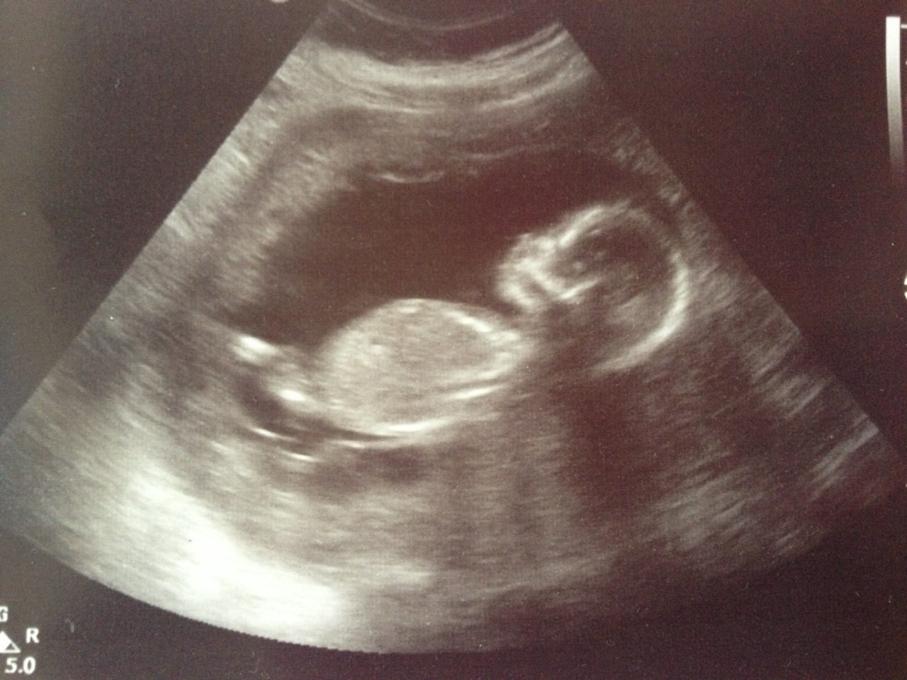 12 Weeks Pregnant Ultrasound Girl