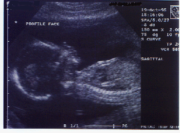 16 Weeks Pregnant Pictures Ultrasound