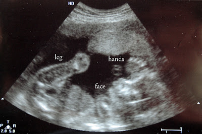 16 Weeks Pregnant Ultrasound Boy Or Girl