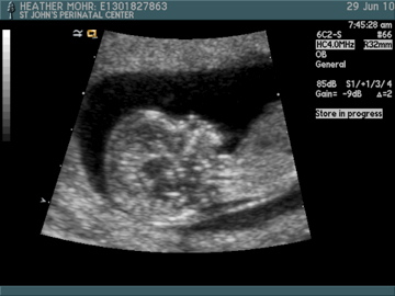 16 Weeks Pregnant Ultrasound Gender Accuracy