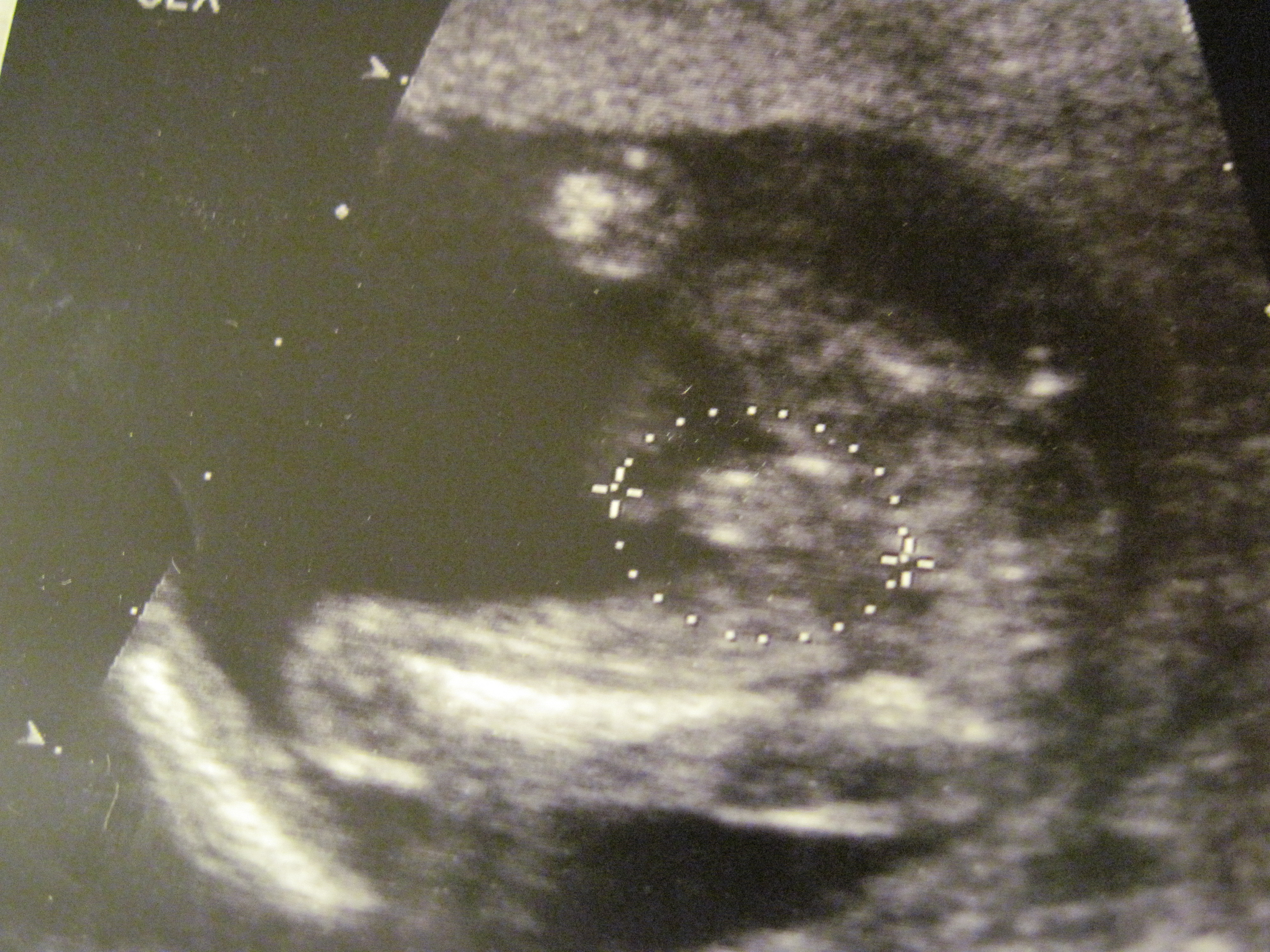 16 Weeks Pregnant Ultrasound Girl