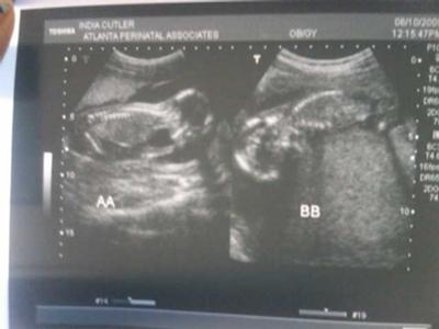 16 Weeks Pregnant With Twins Ultrasound