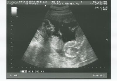 16 Weeks Pregnant With Twins Ultrasound