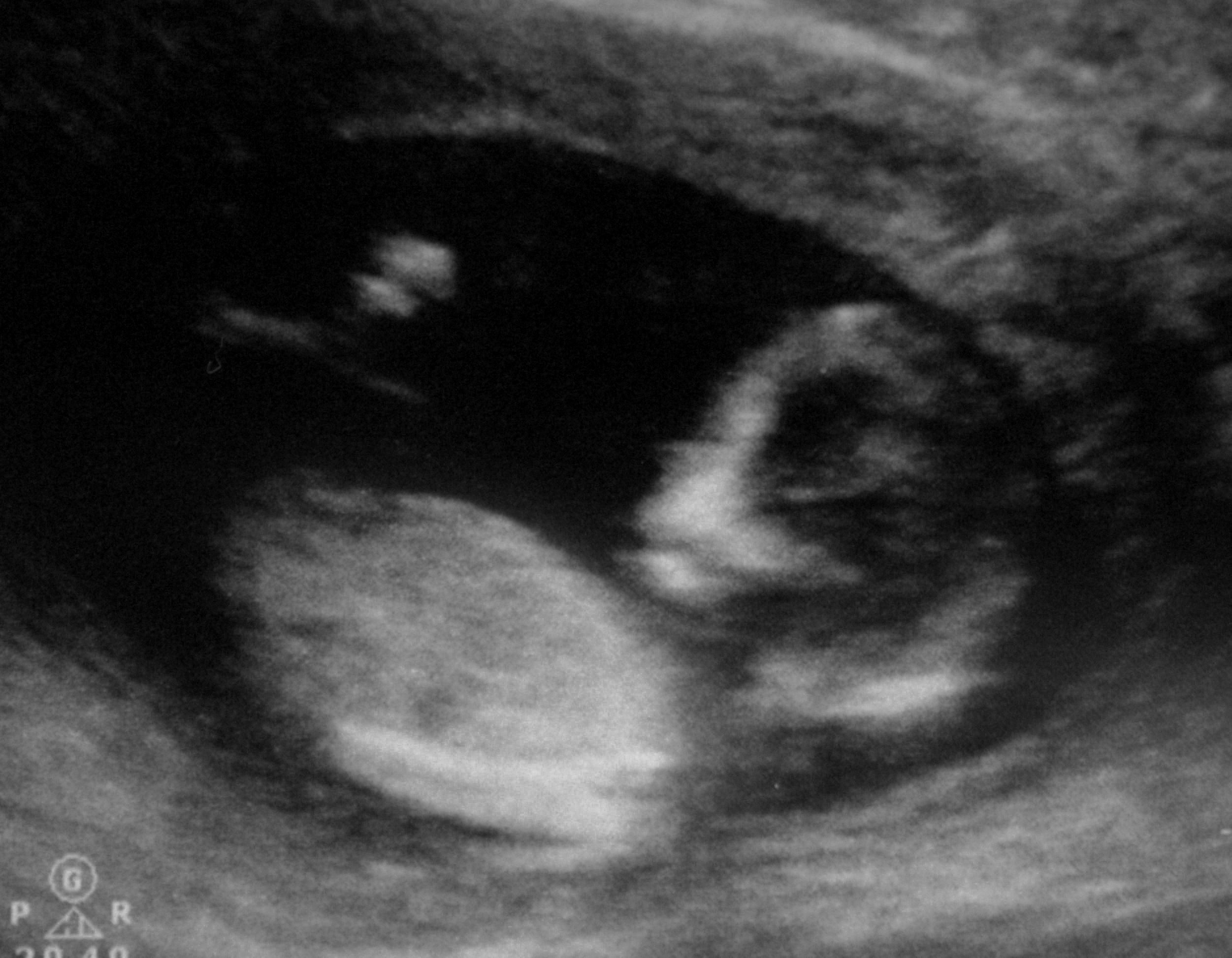 16 Weeks Pregnant With Twins Ultrasound