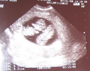 16 Weeks Pregnant With Twins Ultrasound