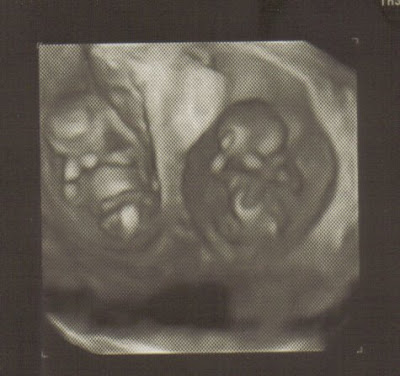 16 Weeks Pregnant With Twins Ultrasound