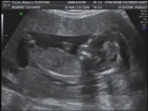 16 Weeks Pregnant With Twins Ultrasound