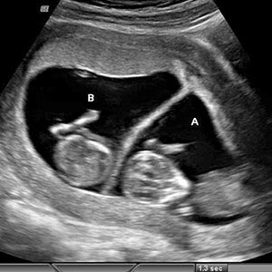 16 Weeks Pregnant With Twins Ultrasound