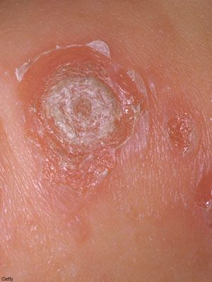 Allergic Contact Dermatitis Blisters