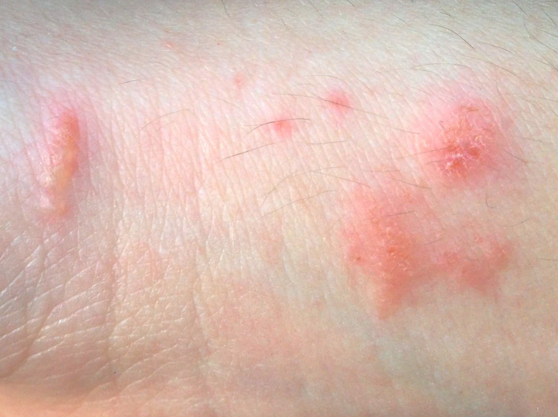 Allergic Contact Dermatitis Blisters