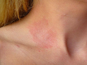 Allergic Contact Dermatitis Blisters