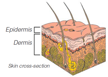 Allergic Contact Dermatitis Blisters