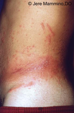 Allergic Contact Dermatitis Blisters