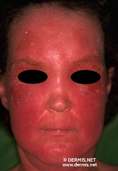 Allergic Contact Dermatitis Face