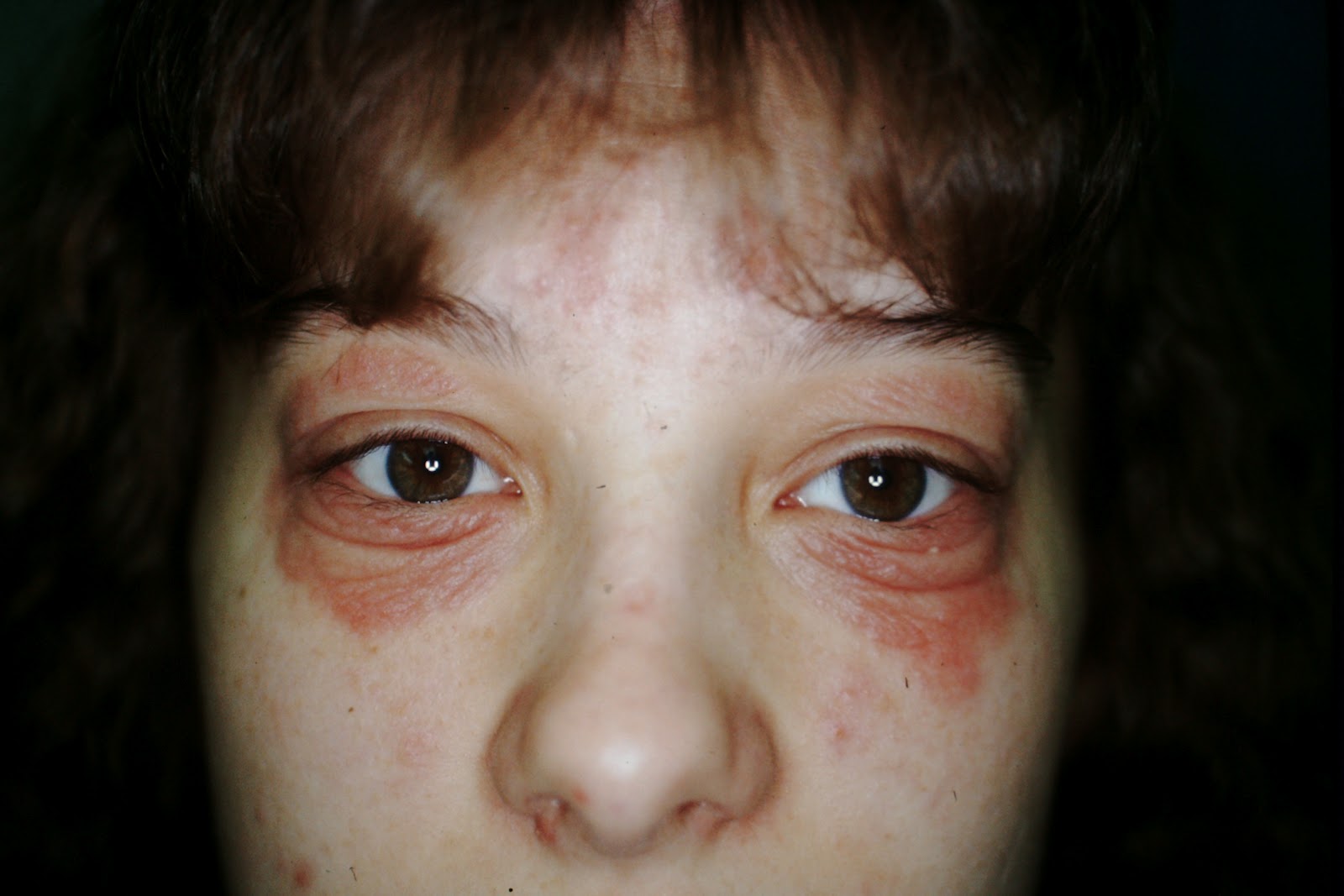 Allergic Contact Dermatitis Face