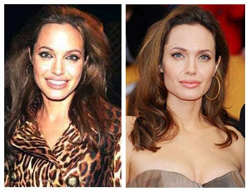 Angelina Jolie Lips Surgery