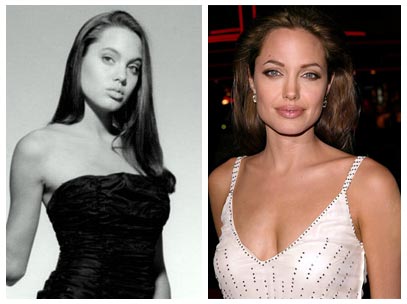 Angelina Jolie Lips Surgery