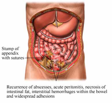 Appendix Burst In Children