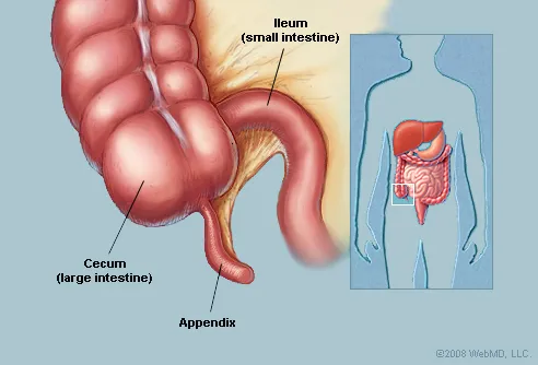 Appendix Burst Surgery