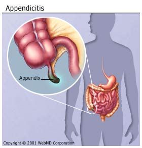 Appendix Burst Symptoms Children