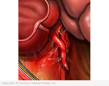 Appendix Operation